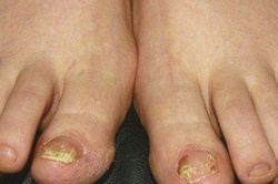 5 dấu hiệu bệnh gan nguy hiểm thể hiện ở bàn chân rất ít người để ý