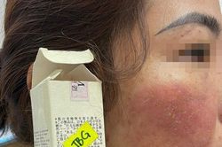 Làm đẹp cấp tốc đón Tết, nhiều ca biến chứng vì tin 'bác sĩ tự phong'