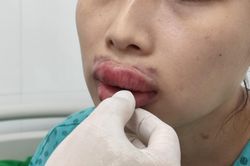 Nhập viện vì biến chứng do đi thẩm mỹ làm đẹp 'cấp tốc' trước Tết