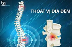 Tập vật lý trị liệu hiệu quả thế nào khi bị phình đĩa đệm và thoái hóa vai gáy?