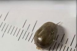 Phát hiện ve chó làm tổ trong ống tai bé 7 tuổi