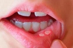 Phân biệt nhiệt miệng và ung thư lưỡi: Cách nhận biết sớm căn bệnh nguy hiểm