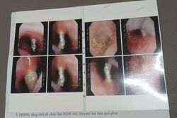 Niềng răng, vít chọc thẳng vào xoang mũi bệnh nhân, bệnh viện nói gì?