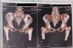 Cứng khớp sau cú ngã nhẹ, bé gái 12 tuổi phát hiện bệnh người hóa đá cực hiếm