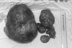 B&oacute;c t&aacute;ch th&agrave;nh c&ocirc;ng khối u ổ bụng nặng gần 8kg sau 6 th&aacute;ng tự d&ugrave;ng thuốc nam