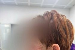 Bác sĩ lưu ý chứng tổn thương da nặng do mắc virus Herpes simplex