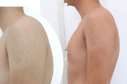 Điều trị gù lưng không cần phẫu thuật