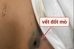 Sốt 5 ngày, bé gái 2 tuổi thoát khỏi sốc nhiễm khuẩn nhờ phát hiện vết đốt mò