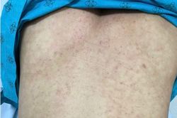 Người đ&agrave;n &ocirc;ng 45 tuổi nguy kịch v&igrave; mắc sởi lại tưởng cảm c&uacute;m