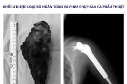 Thay khớp vai đảo ngược, giữ lại cánh tay cho bệnh nhi 14 tuổi ung thư xương