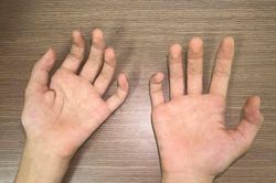 Teo cơ bàn tay ở người trẻ: Cảnh giác với bệnh Hirayama hiếm gặp