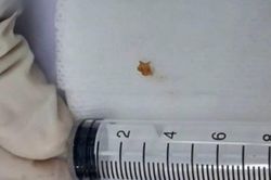 Tưởng viêm phế quản, bé 3 tuổi mắc dị vật đường thở suốt hơn 1 tháng