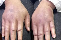 Nghe theo quảng c&aacute;o ti&ecirc;m chất bị Bộ Y tế cấm sử dụng trong l&agrave;m đẹp, người phụ nữ nhận c&aacute;i kết qu&aacute; đắng