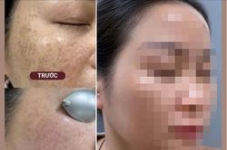 Thực hư chuyện 'cải lão hoàn đồng' bằng tia laser