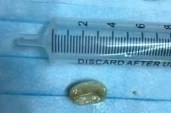 Ho kéo dài tưởng viêm phế quản, hóa ra có hạt lạc mắc trong phổi