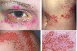 Đau rát, như điện giật sau zona kéo dài hơn 1 năm