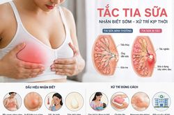 Bác sĩ cảnh báo biến chứng viêm vú khi tự 'thông tia' sữa