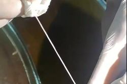 Việt Nam ghi nhận ca mắc giun rồng thứ 44: Kéo ra 2 đoạn 'giun trắng' dài hàng chục cm từ cánh tay