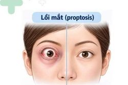 Mắt lồi, mất dần thị lực do khối u nằm sâu sau nhãn cầu