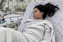 Đèn pin sạc bốc cháy lúc nửa đêm, bé gái 14 tuổi bỏng đường thở nguy kịch