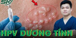 Có phải HPV dương tính là bị ung thư cổ tử cung không?