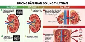 Đau lưng kéo dài, người đàn ông 45 tuổi phát hiện ung thư thận