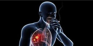 Ung thư đầu cổ có liên quan trực tiếp đến thuốc lá