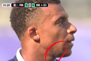 Nốt sần sùi trên mặt Mbappe thu hút gần 60 triệu view