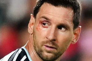 Lý do mắt Messi rướm máu