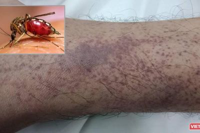 Cảnh giác với căn bệnh chưa có vaccine vào đỉnh dịch trong tháng 11