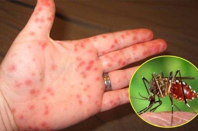 12.200 trường hợp mắc sốt xuất huyết