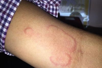 Dùng thuốc điều trị giun chỉ cần lưu ý gì?