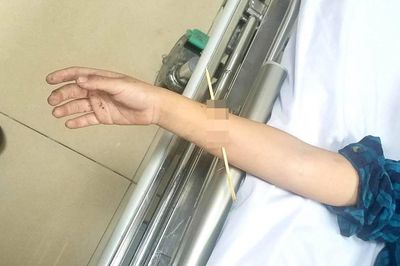Bé trai bị que tre đâm xuyên cẳng tay