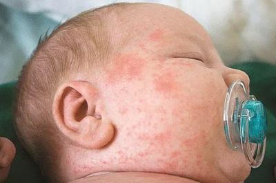 Bị sởi không nên làm gì để rút ngắn thời gian điều trị?