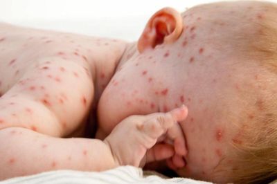 5 bệnh nguy hiểm mà trẻ thường mắc vào mùa hè