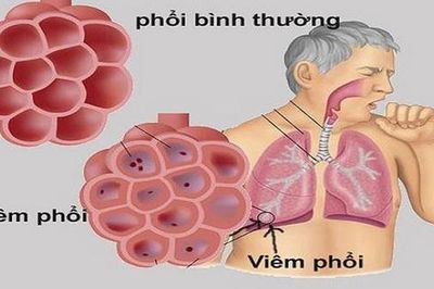 Những bệnh dễ gặp ở phổi và lời khuyên phòng bệnh từ bác sĩ