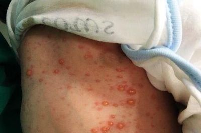 Ba mẹ con lây bệnh thủy đậu cho nhau, bác sĩ chỉ cách phòng bệnh cần biết
