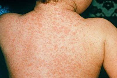 Chẩn đoán và xử lý kịp thời khi bị sốt phát ban do bệnh Rubella
