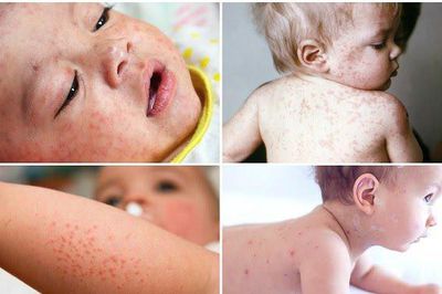 Mắc bệnh Rubella phải kiêng tắm gội không?