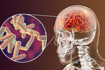 Nguy hiểm biến chứng não do bệnh Rubella và những thông tin quan trọng