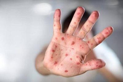 Chăm sóc trẻ bị tay chân miệng tại nhà: 5 việc quan trọng cần làm