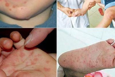 Các tỉnh Nam Trung Bộ: Cảnh giác với ca bệnh tay chân miệng