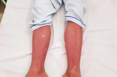 Cảnh báo nhiều ca mắc sốt xuất huyết trong tình trạng nặng