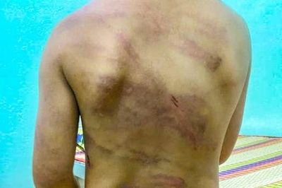 Yêu cầu xử nghiêm vụ cha dượng bạo hành bé gái 7 tuổi