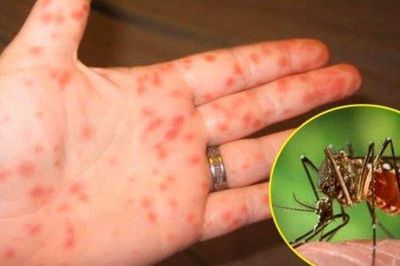 Cần làm gì khi trẻ bị sốt xuất huyết kèm co giật?