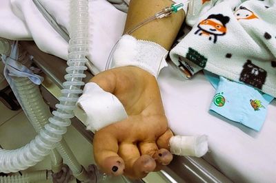 TP.HCM ghi nhận số ca tử vong do sốt xuất huyết cao nhất 10 năm, chủ yếu là người lớn