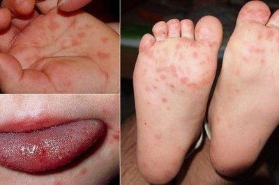 Cuối năm trẻ mắc bệnh tay chân miệng tăng
