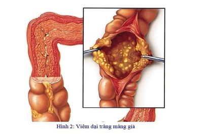 Mối nguy hại từ việc điều trị kháng sinh dài ngày