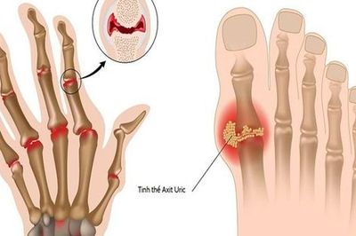 Acid uric bao nhiêu là mắc bệnh gout?