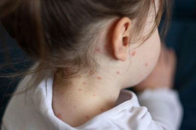 Lý do khiến dịch sởi bao trùm châu Âu